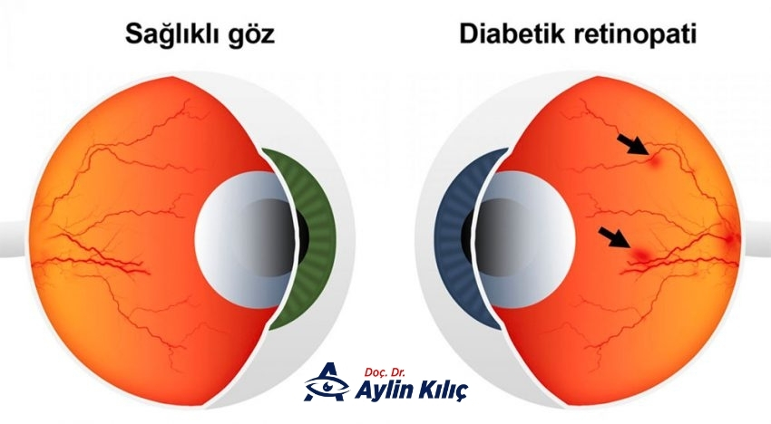 diyabetik retinopati