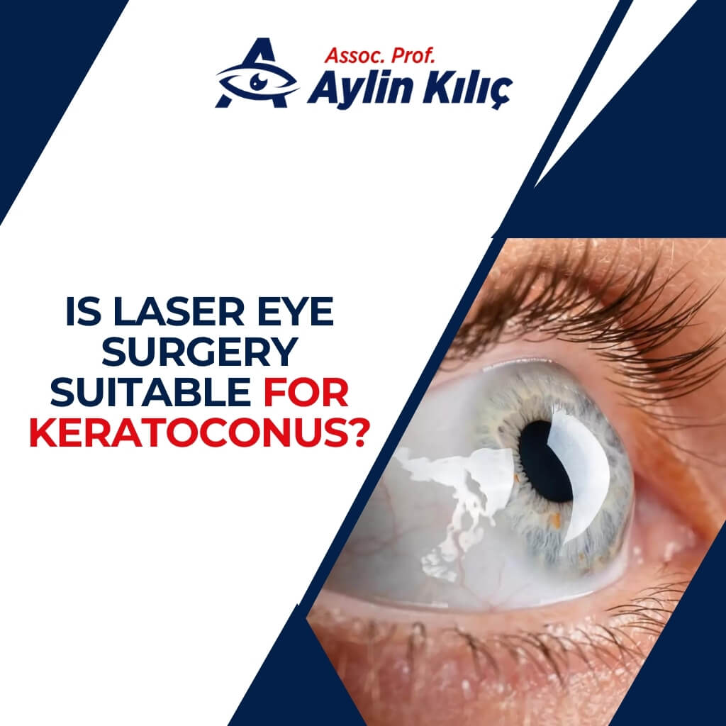 Can Keratoconus Patients Get Laser 1 1 1