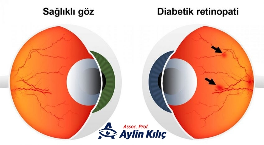 Does Diabetes Affect the Eye
