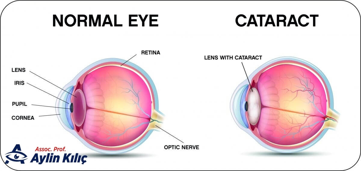 Things to Consider After Cataract Surgery