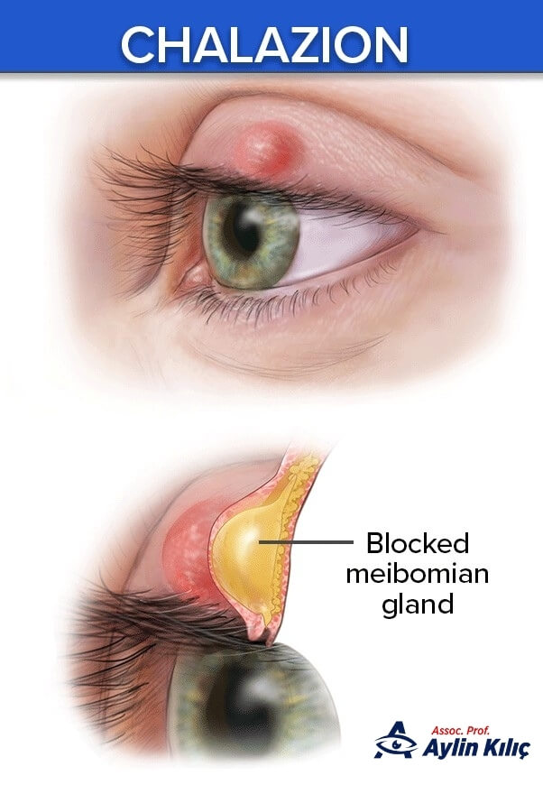 What is Chalazion