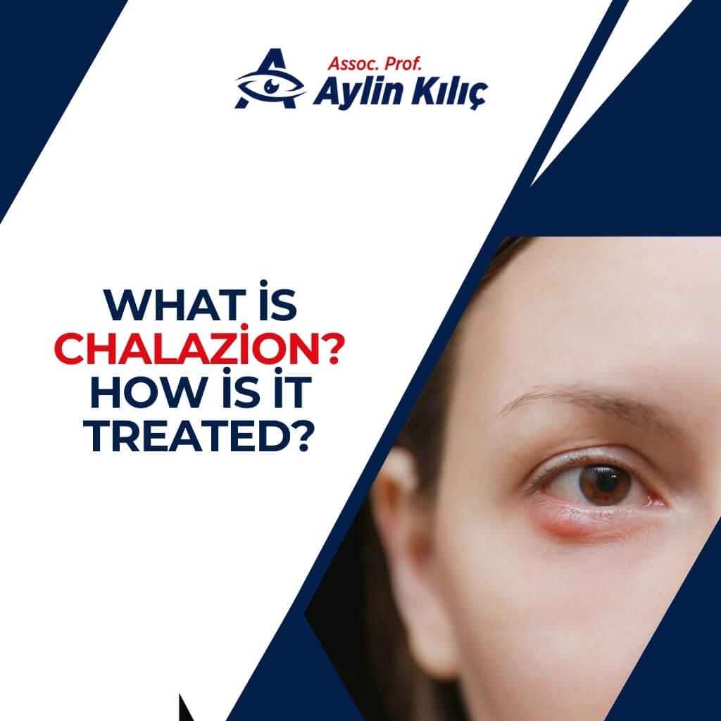 What is Chalazion How is it treated