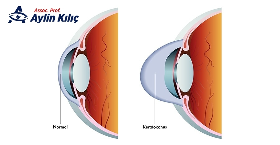 What happens if keratoconus is diagnosed late