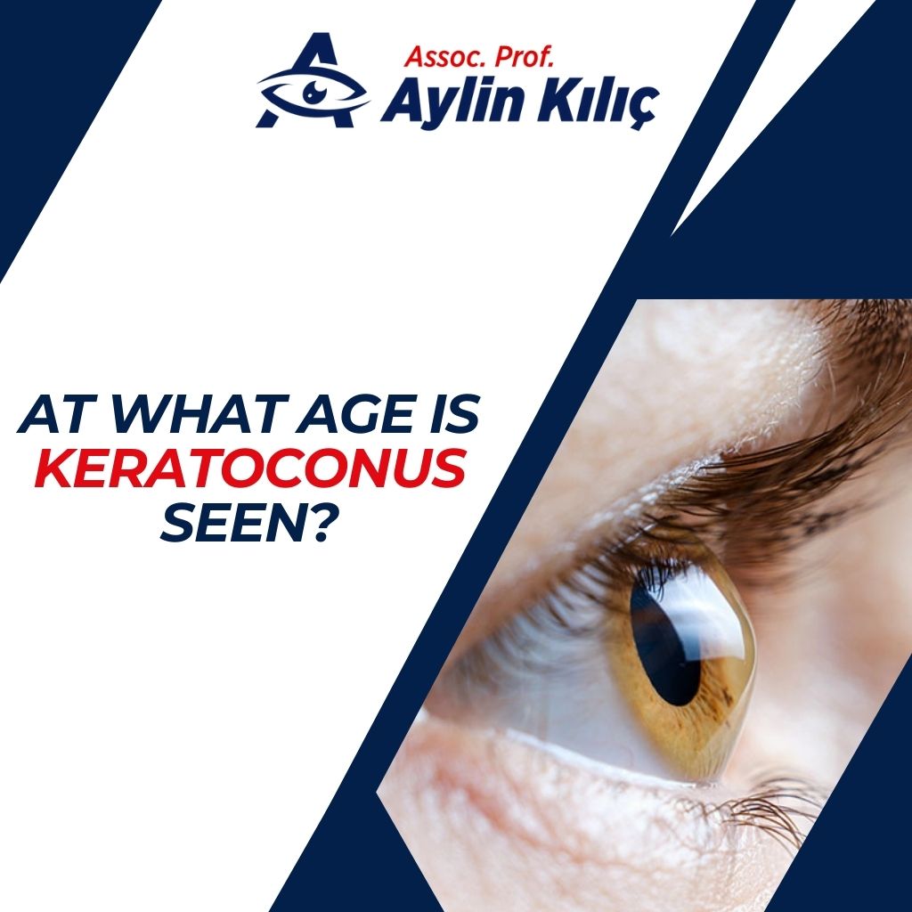 At what age is keratoconus seen ENG
