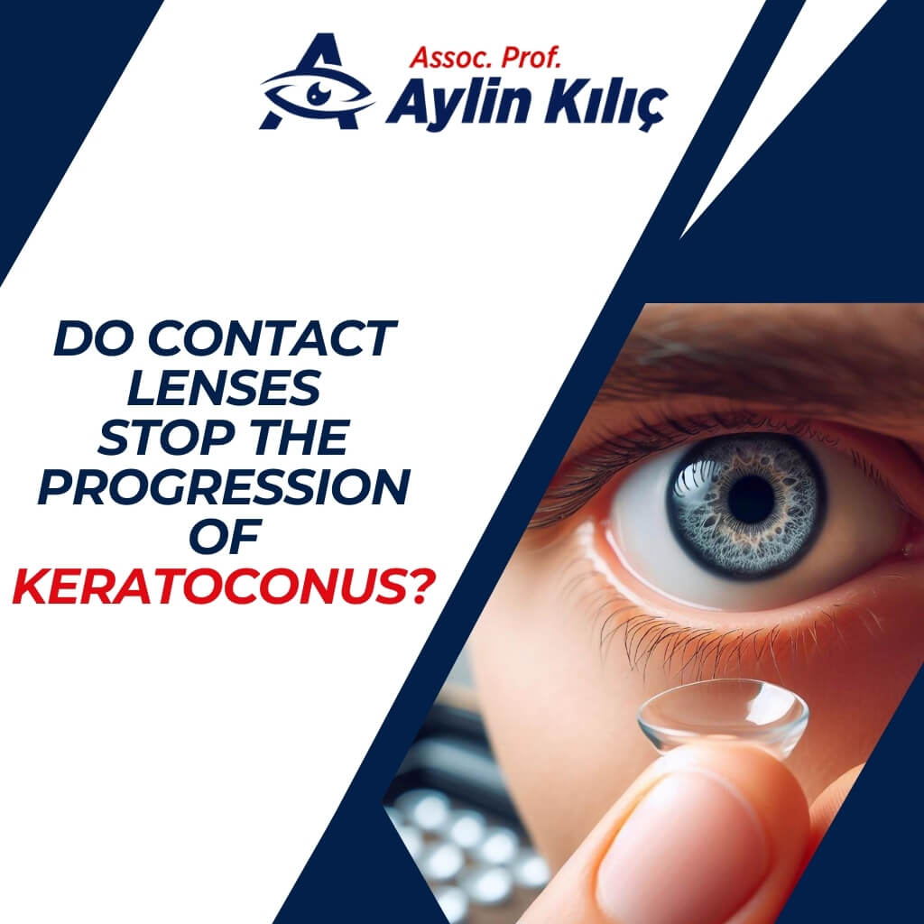Do Contact Lenses Stop the Progression of KeratoconusENG 1