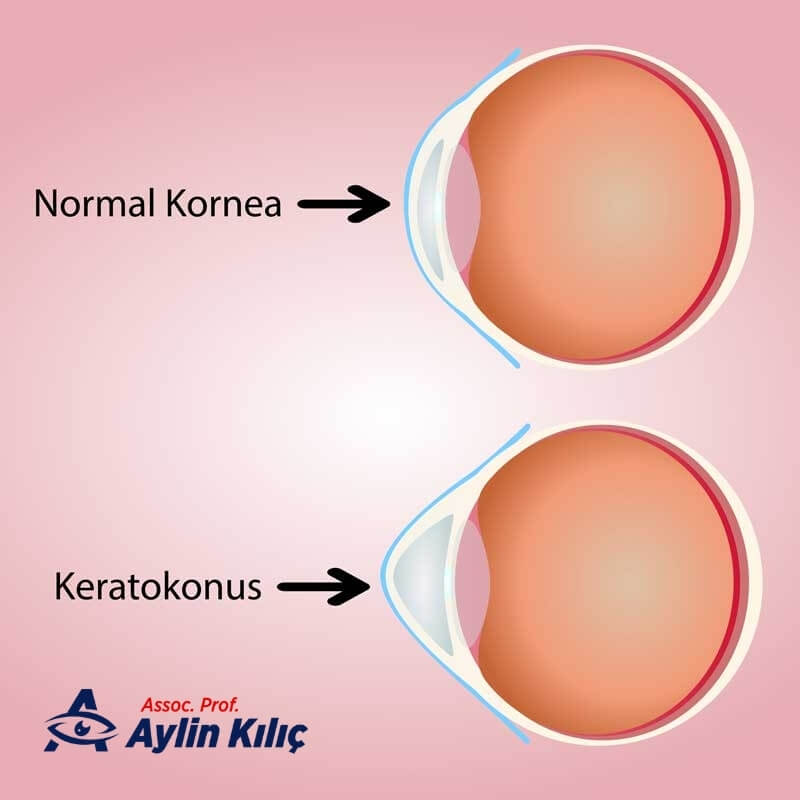 Does Keratoconus Disease Cause Blindness