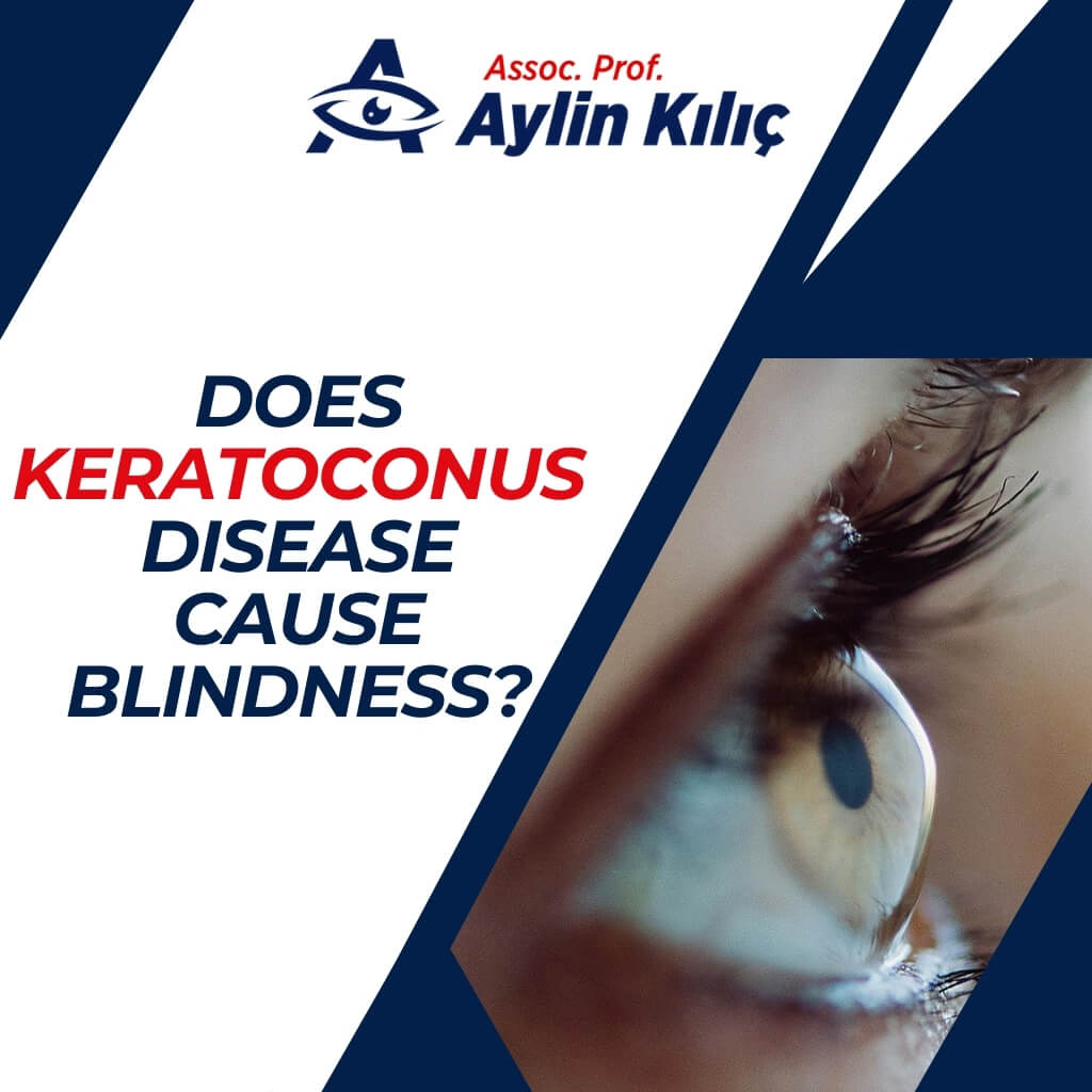 Does Keratoconus Disease Cause Blindness