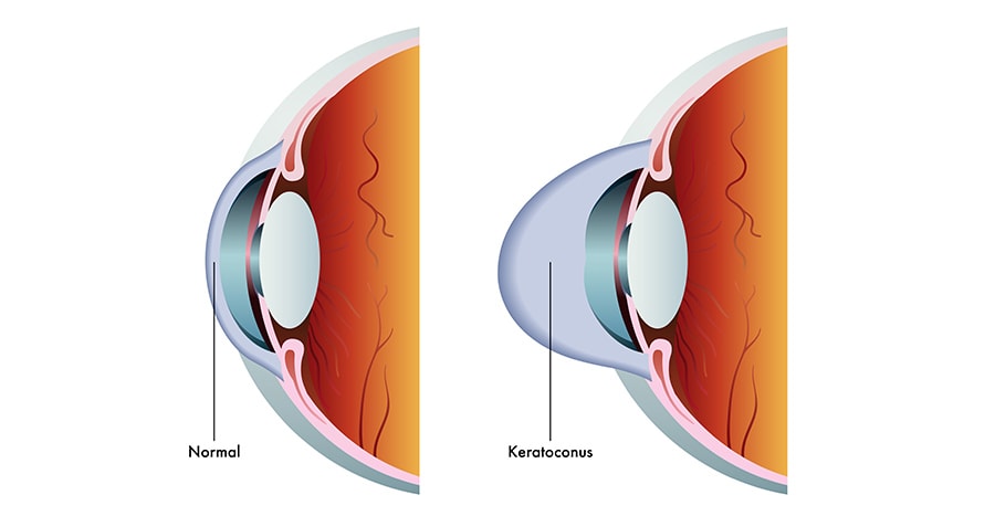 Keratokonus hangi yaşlarda görülür