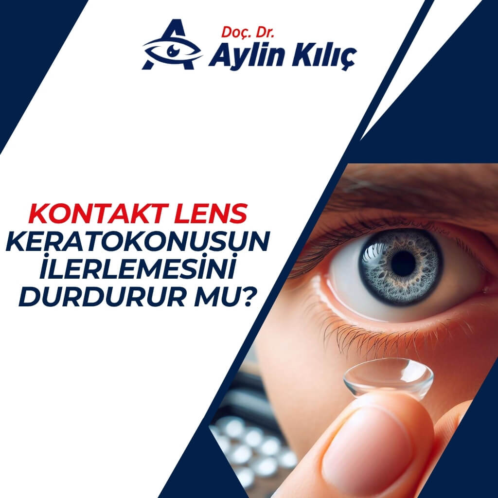 Kontakt Lensler Keratokonus Turkce 1