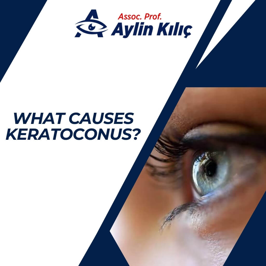 What Causes KeratoconusENG 1