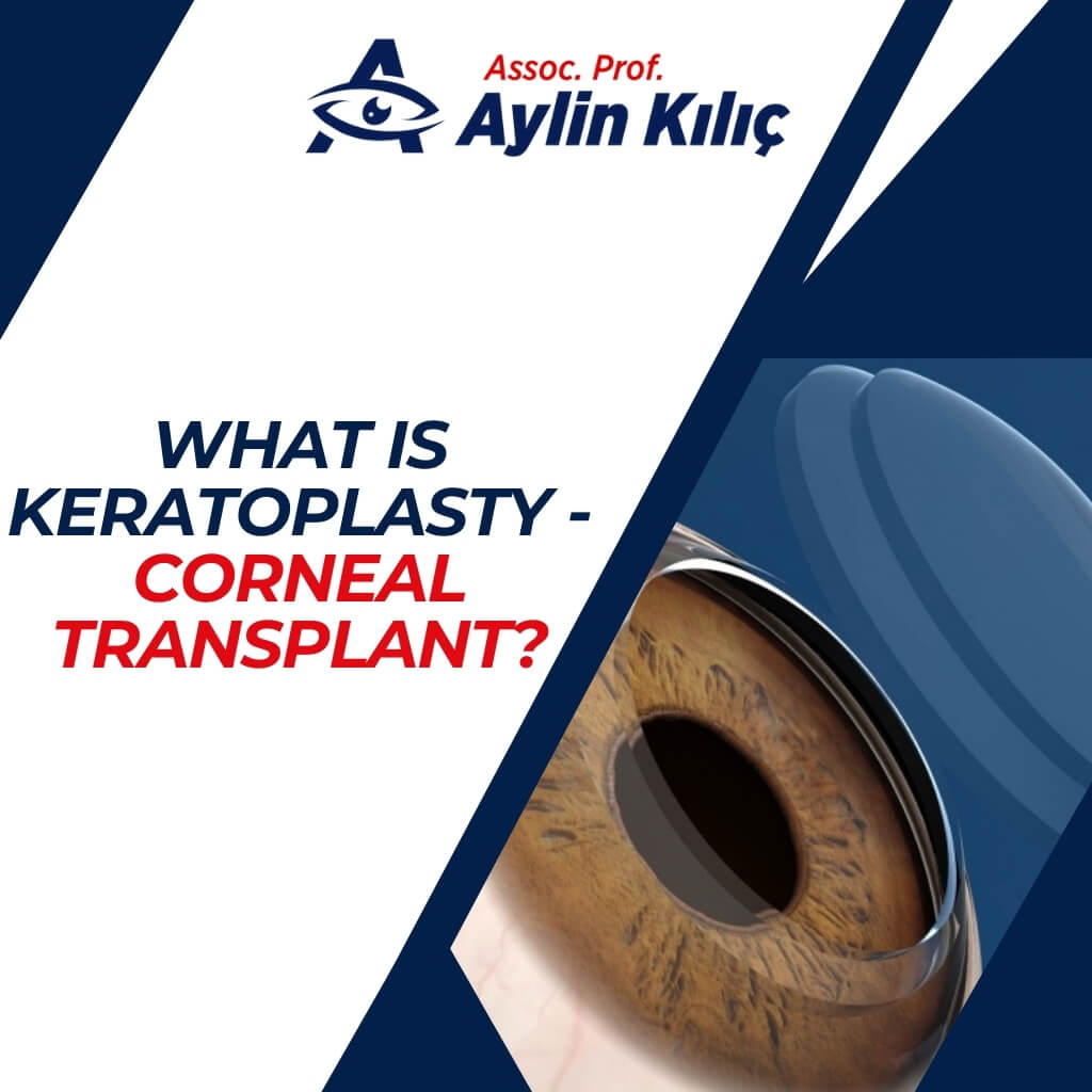 What Is Keratoplasty - Corneal Transplant