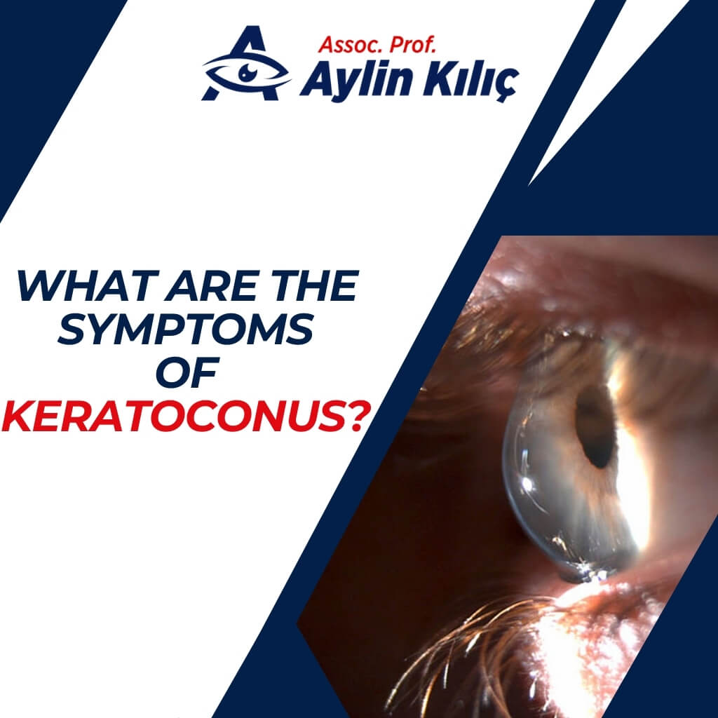 What are the Symptoms of Keratoconus