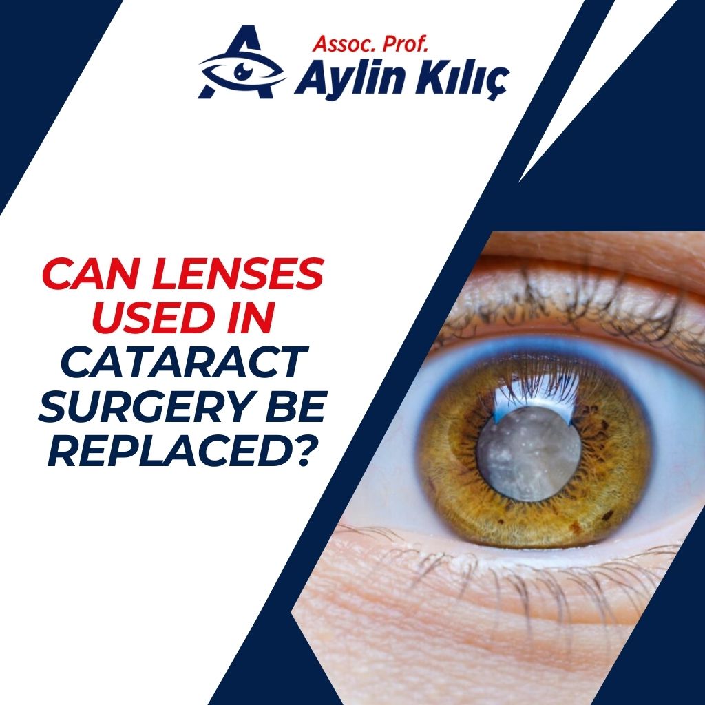 Can Lenses Used in Cataract Surgery Be Replaced