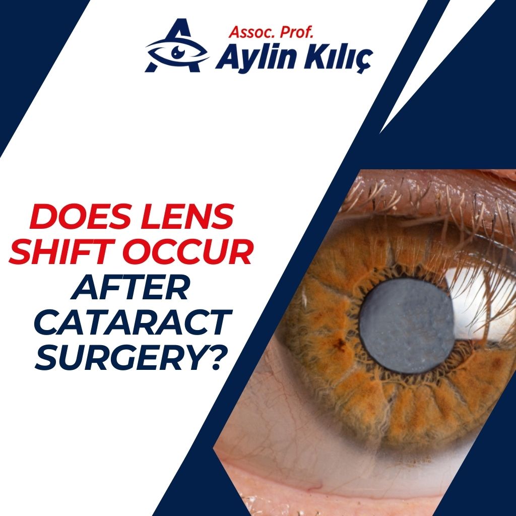 Does Lens Shift Occur After Cataract Surgery?