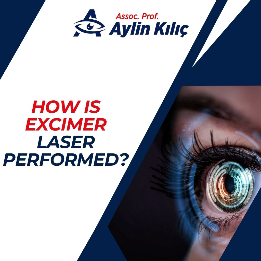How is Excimer Laser Performed
