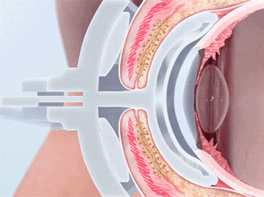 LipiFlow GIF