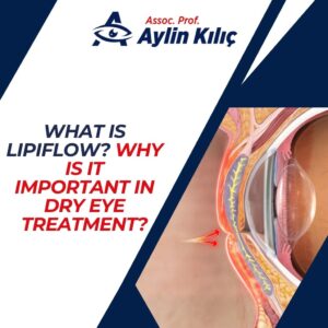 What is Lipiflow Why is it Important in Dry Eye Treatment 2